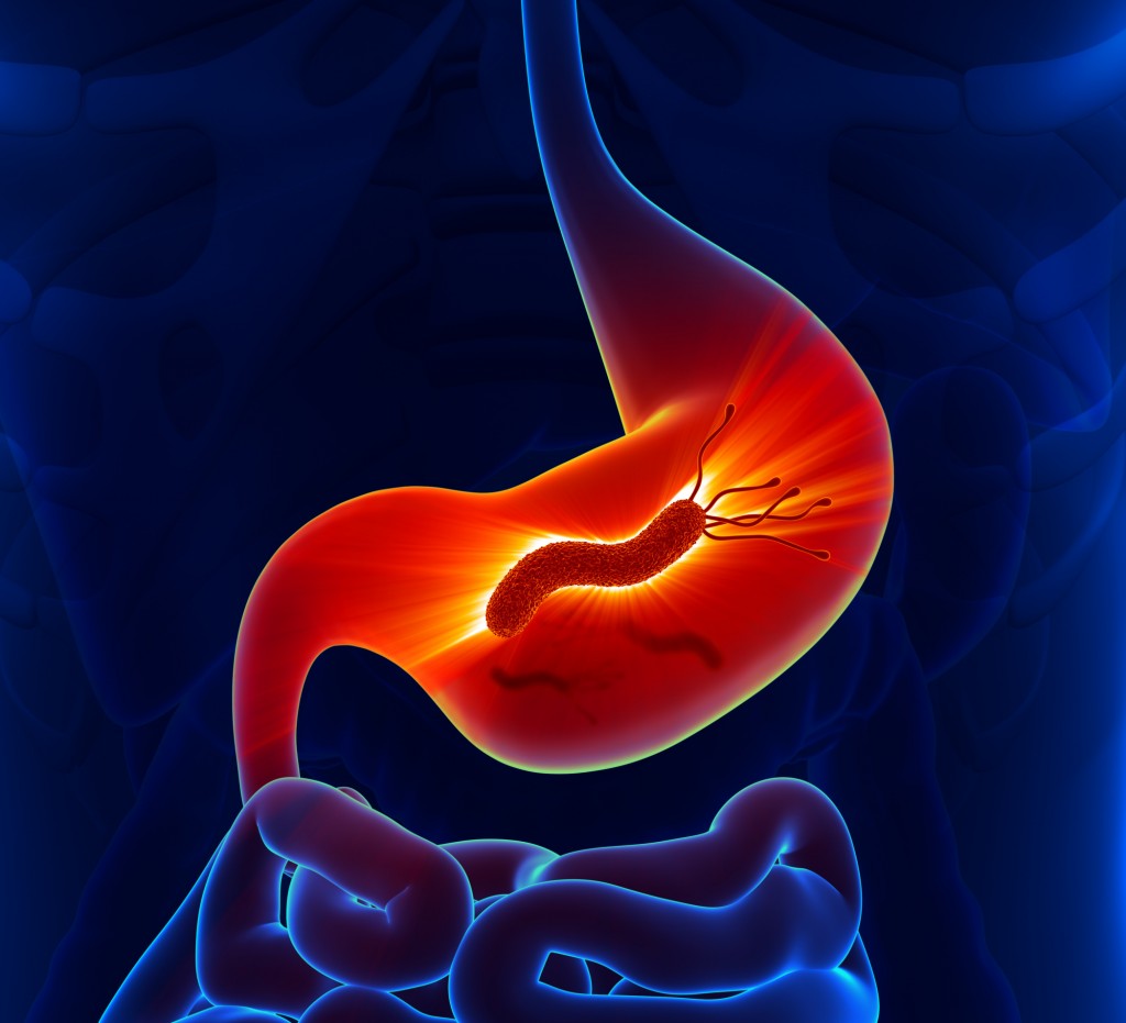 Антитела класса IgG к Helicobacter pylori  (Anti H. pylori IgG)